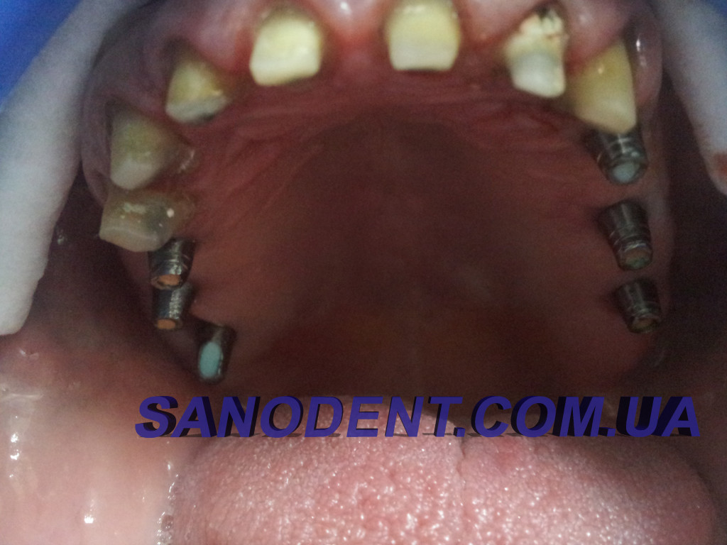 Протезирование зубов Харьков | протезирование зубов безметалловая керамика E-max