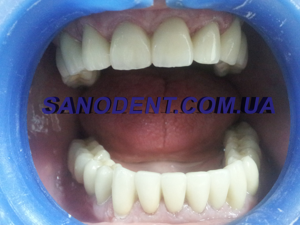 Протезирование зубов Харьков | протезирование зубов безметалловая керамика E-max