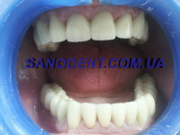 Протезирование зубов Харьков | протезирование зубов безметалловая керамика E-max