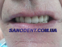 Протезирование зубов Харьков | протезирование зубов безметалловая керамика E-max