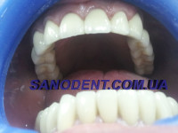 Протезирование зубов Харьков | протезирование зубов безметалловая керамика E-max