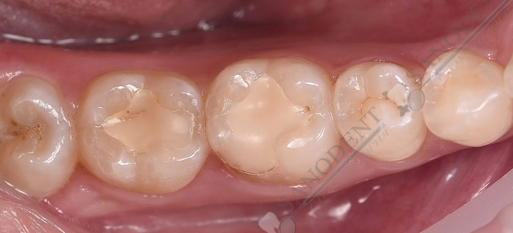 старые пломбы убираем