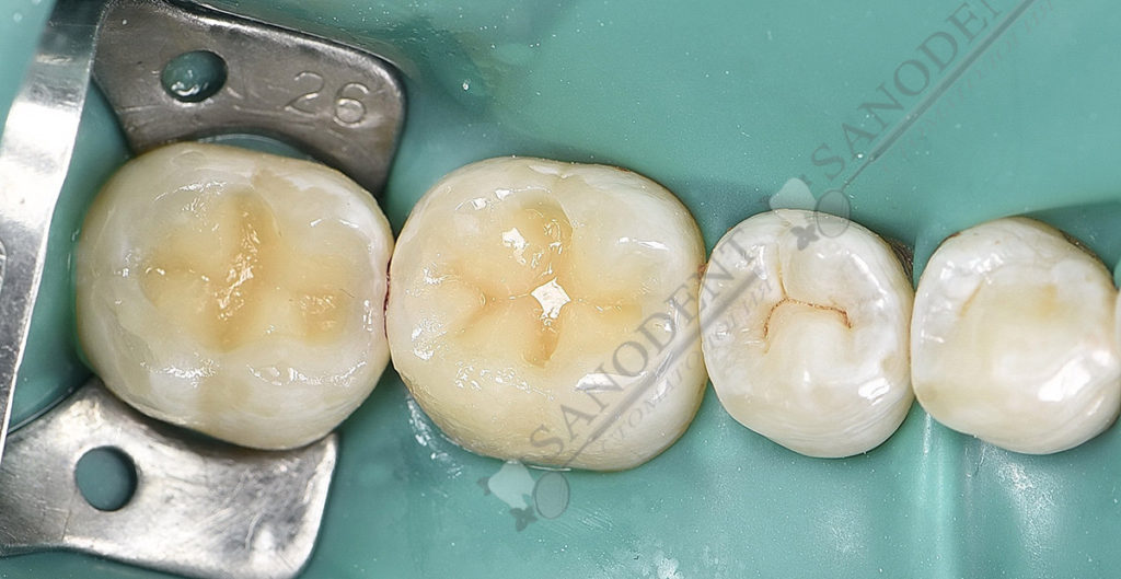 реставрируем зубы