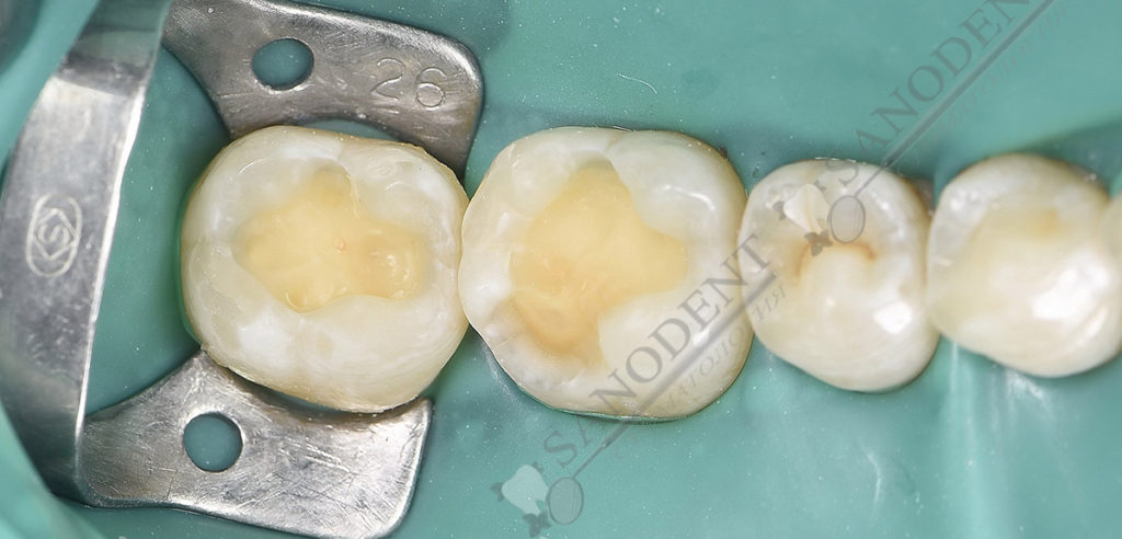 в процессе реставрации и лечения