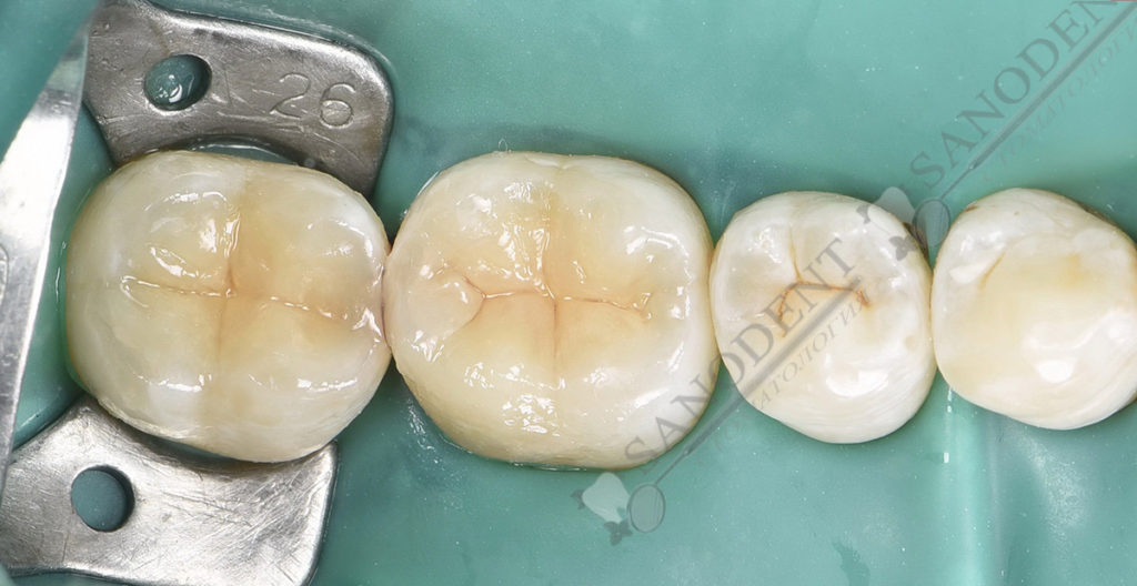 после художественной реставрации зубов