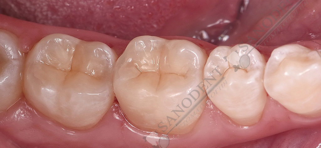 художественная реставрация зубов