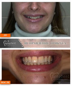 исправление прикуса металлические брекеты-до и после