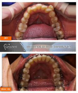 брекеты металлические фото до и после