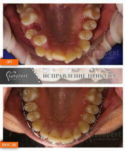 брекеты Харьков