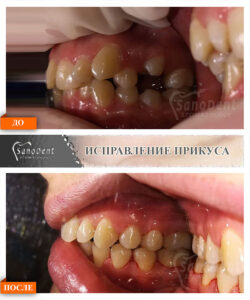 брекет-система металлическая