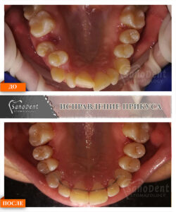 выравнивание зубов в Харькове, металлические брекеты