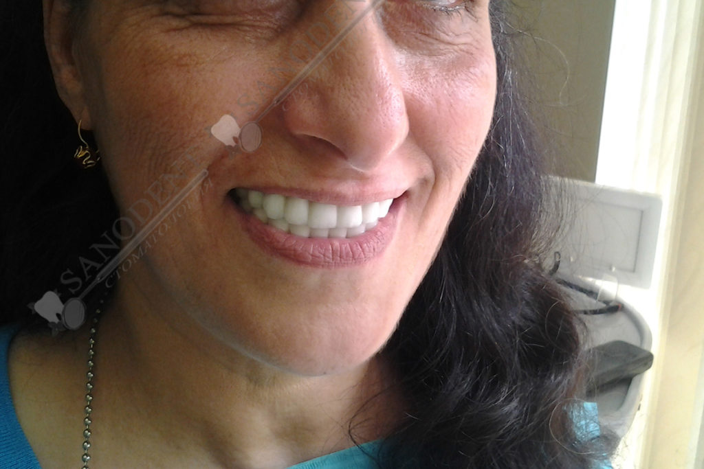 металлокерамические коронки на имплантах