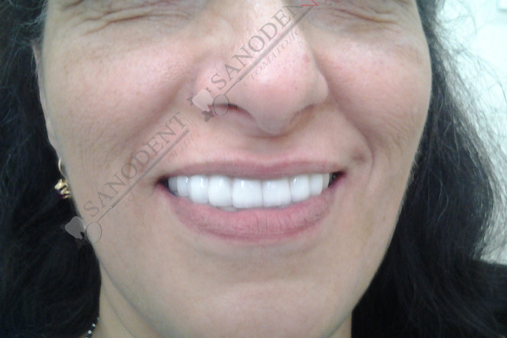 вид после протезирования на имплантах