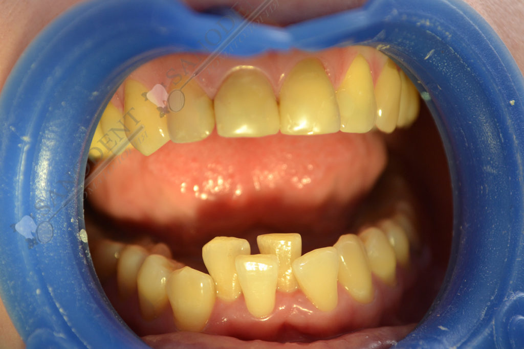 исправление прикуса винирами