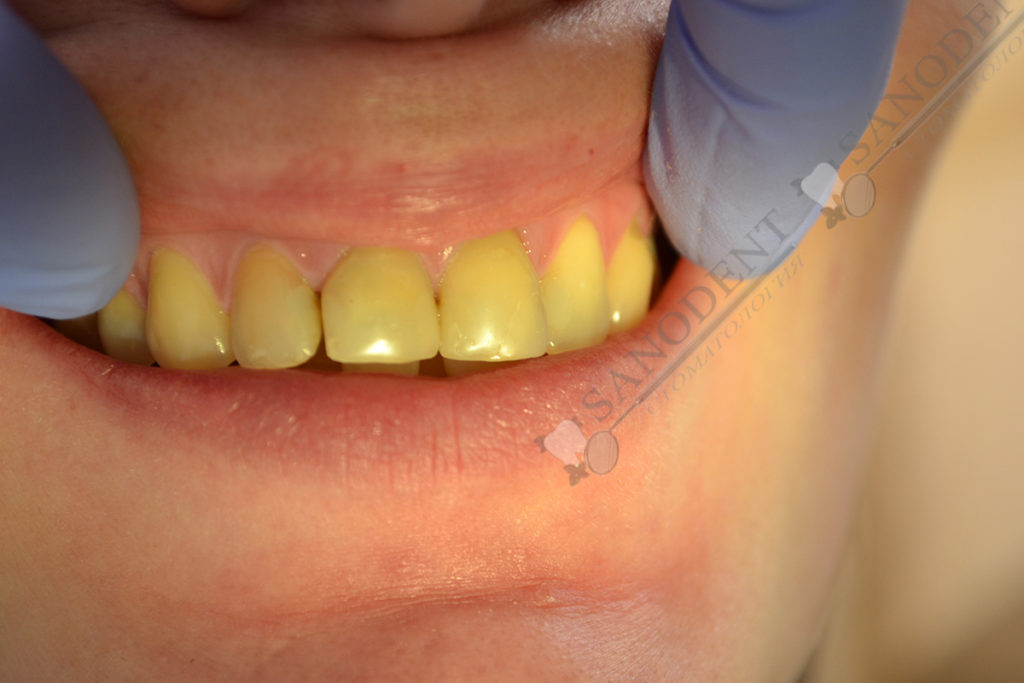 фото до протезирования e-max