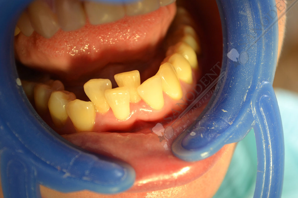 нарушение прикуса на нижней челюсти