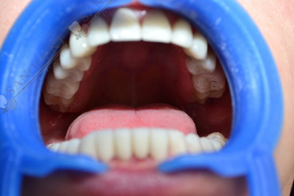 установленные виниры на зубы фото