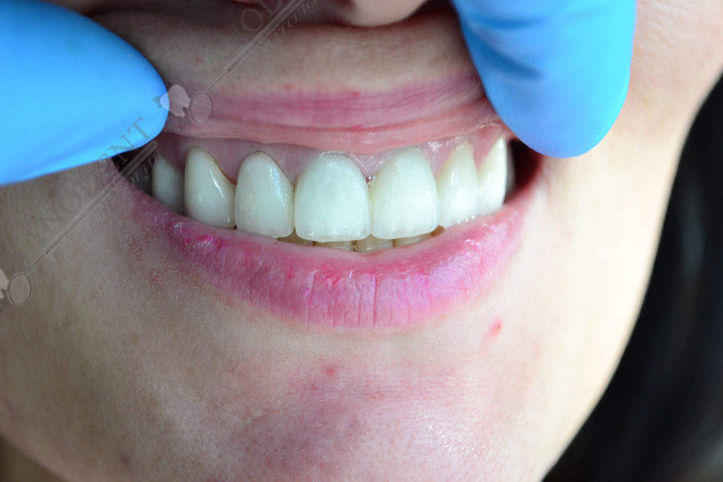 внешний вид виниров на зубах