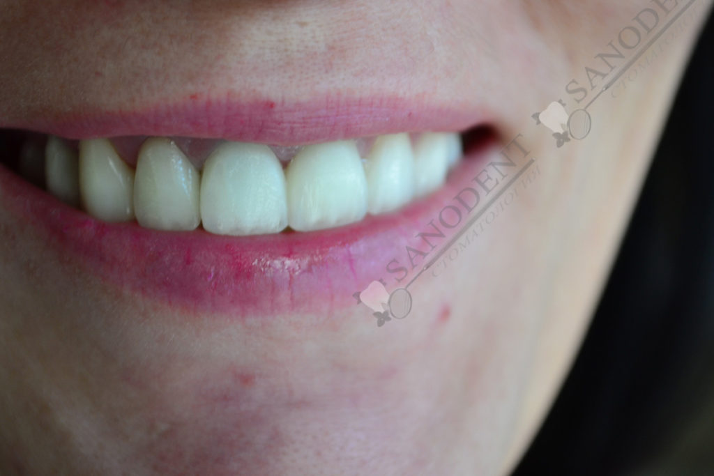 виниры после установки