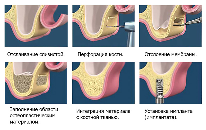 Этапы операции синус-лифтинг, пластика костной ткани