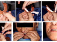 подгонка съемного протеза