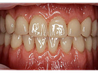 вид полного съемного протеза в трех положениях