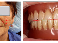 особнности съемного протезирования