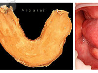 снятие слепка беззубой челюсти