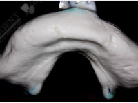 слепок беззубой челюсти