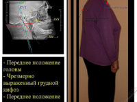 оценка постуральных данных пациента
