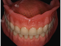 полный съемный протез