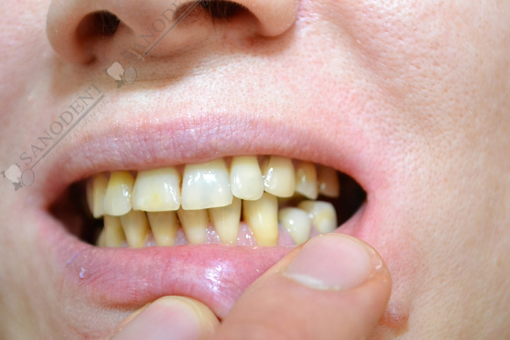 желтые зубы с дефектами эмали