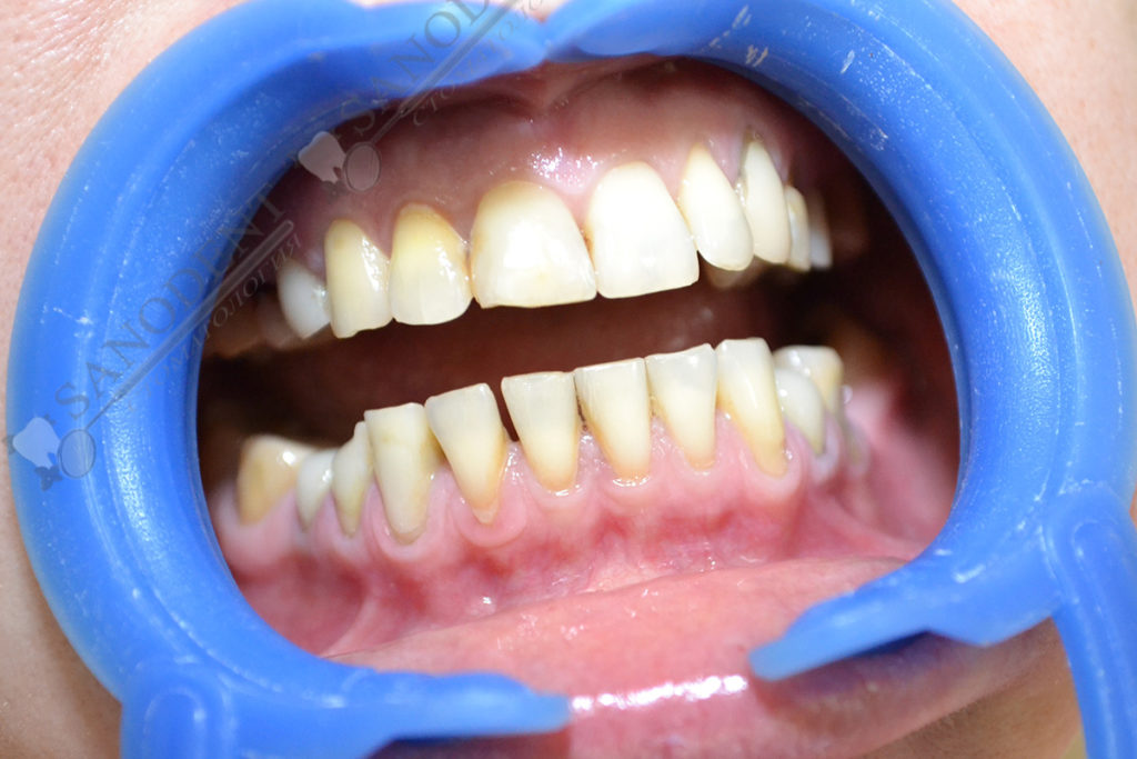 фото до установки керамических виниров на зубы