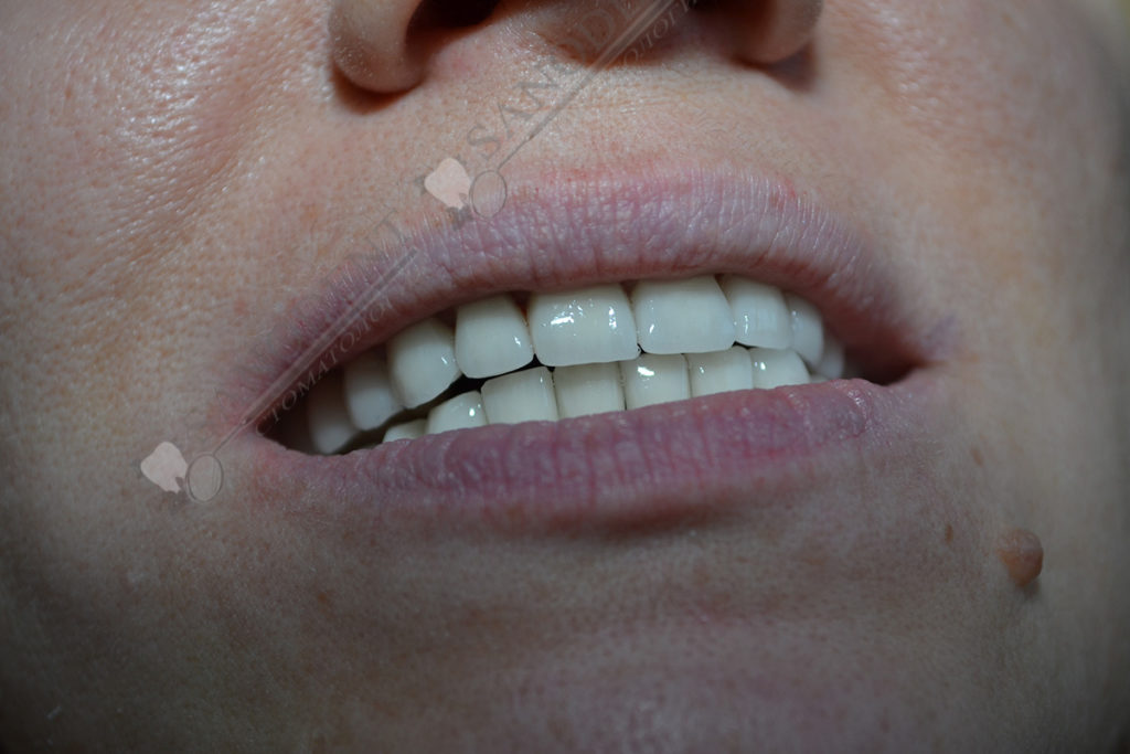 виниры - после установки на зубы