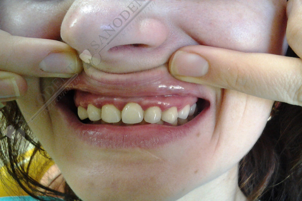 фото до протезирования винирами