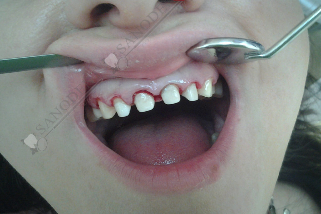 препарация зубов под виниры