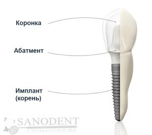 схема строение и компонентов имплантированного зуба