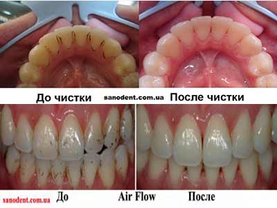 Чистка зубов в стоматологии: фото до и после ❘ ОртодонтКомплекс