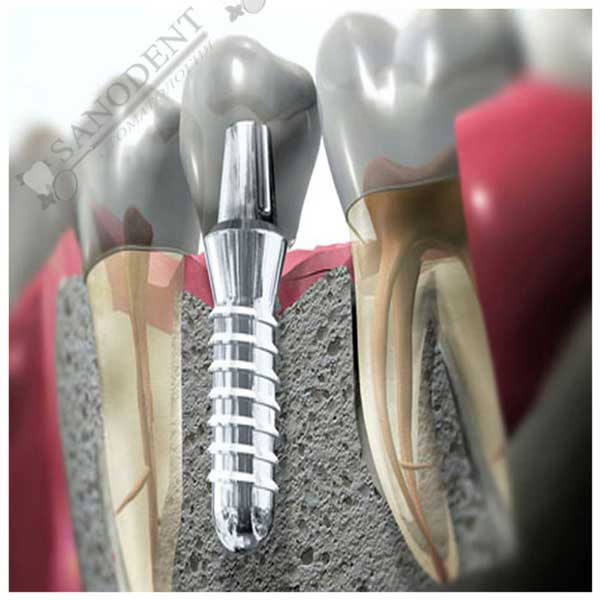 Стоматологические работы Санодент - имплантация зубов, протезирование зубов на имплантах