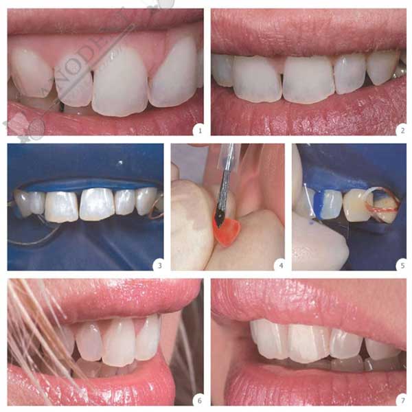 Стоматологические работы Санодент - эстетические реставрации зубов, пломбы