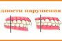 Виды нарушения прикуса