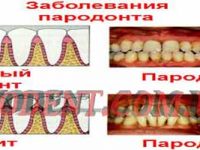 Лечение гингивита и пародонтита аппаратом Вектор