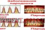 Заболевание пародонта, лечение пародонта в Харькове