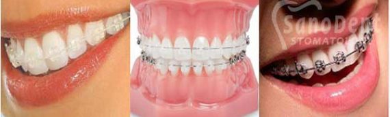 Стоимость установки брекет-системы или сколько стоят брекеты, цена на брекеты в Харькове?