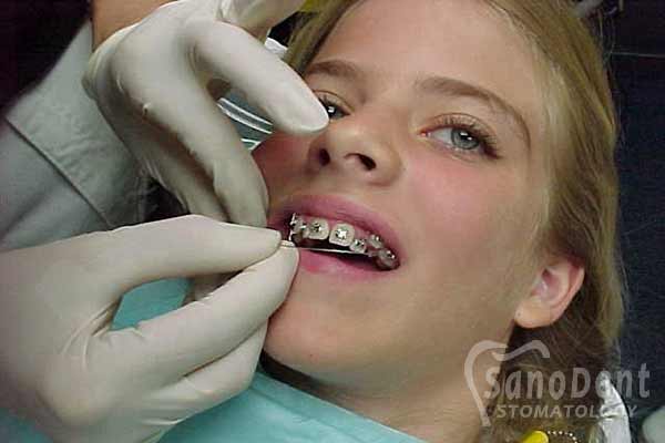 установка брекетов на зубы в Харькове