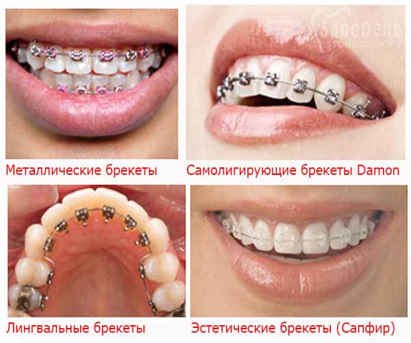 Сапфировые брекеты – цена установки в Москве