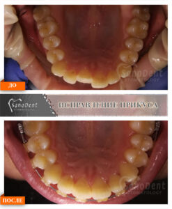 исправление прикуса брекеты сапфировые