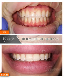 Сапфировые брекеты фото до после