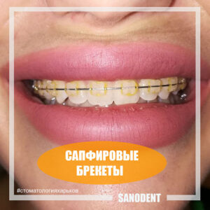 прозрачные брекеты Харьков