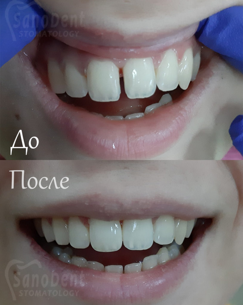 закрытие диастемы (Щель между зубами) прямая реставрация